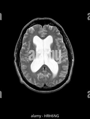 MRI Communicating Hydrocephalus (NPH) Stock Photo
