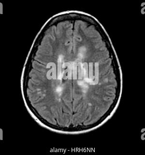 MRI of Multiple Sclerosis Stock Photo - Alamy