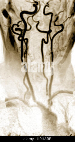 Stenosis of the Internal Carotid Arteries Stock Photo