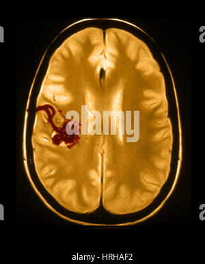MRI of Arterial Venous Malformation Stock Photo