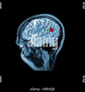 MRI of Brain AVM Stock Photo