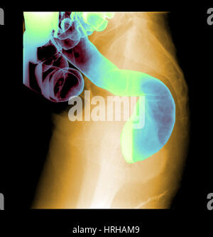 Barium enema exam Stock Photo