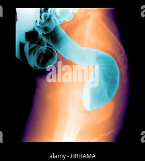 Barium enema exam Stock Photo