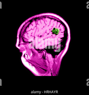 MRI of Brain AVM Stock Photo