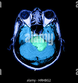 MRI of Acute MS Stock Photo