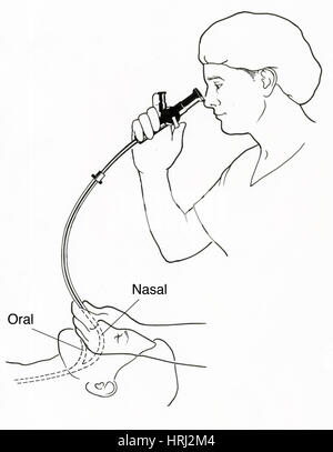 Illustration of Endoscopy Stock Photo