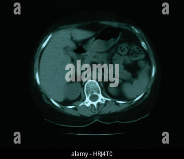 Granuloma & Calcification in Lung Stock Photo