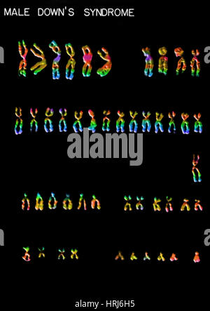 Down's Syndrome karyotype Stock Photo