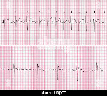 Cardioversion, 2 of 2 Stock Photo - Alamy