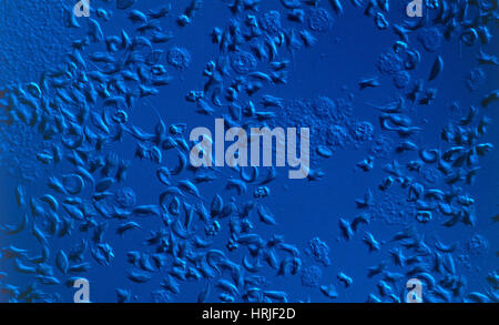 Sickle Cell Anaemia Stock Photo