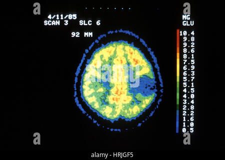 A PET scan (positron emission tomography) 62 year old man brain tumor ...