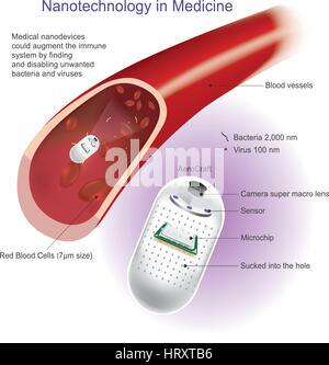 Angioplasty (or Balloon angioplasty) is an endovascular procedure to widen narrowed or obstructed arteries or veins, typically to treat arterial ather Stock Vector