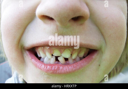 Gappy teeth Stock Photo