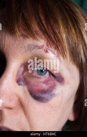 black eye face haematoma Stock Photo