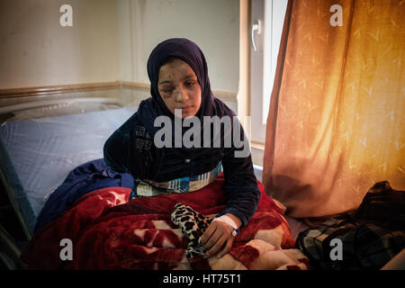 Injured Iraq civilian woman age 19 who lost her right arm and eye when a bomb fell on her house in during fighting to liberate Mosul, Iraq Stock Photo