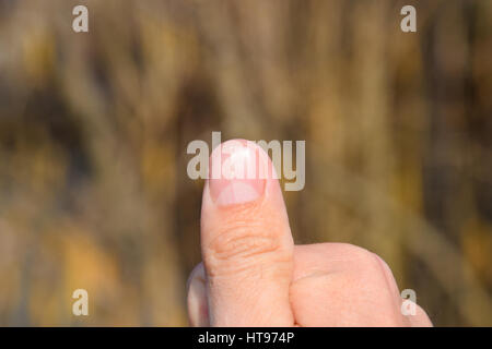 Forked nail on the thumb. Dilation of the nail, traumatic pathology. The nail is divided in half. Stock Photo
