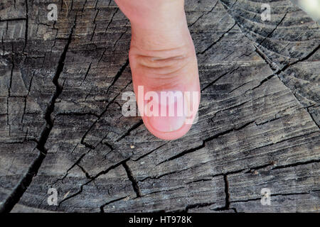 Forked nail on the thumb. Dilation of the nail, traumatic pathology. The nail is divided in half. Stock Photo