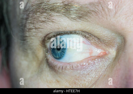 Sun burn damage to eye, known as Pinguecula causes a hardening lump on the eye Stock Photo