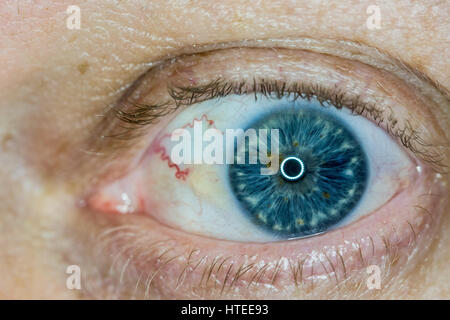 Sun burn damage to eye, known as Pinguecula causes a hardening lump on the eye Stock Photo