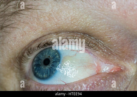 Sun burn damage to eye, known as Pinguecula causes a hardening lump on the eye Stock Photo