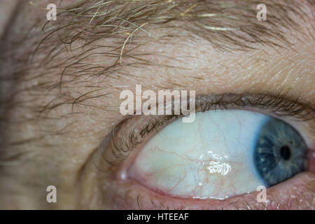 Sun burn damage to eye, known as Pinguecula causes a hardening lump on the eye Stock Photo