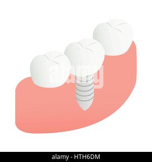 Tooth Implant icon, isometric 3d style Stock Vector