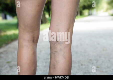 Girl`s Legs in Compression Stockings for Varicose Veins. Pregnancy