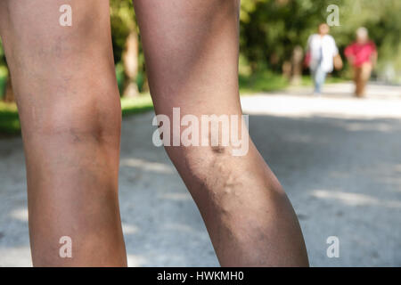 Painful varicose and spider veins on womans legs, who is active and working out, self-helping herself in overcoming the pain. Stock Photo