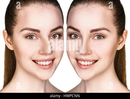 Young woman before and after cosmetic nose surgery Stock Photo