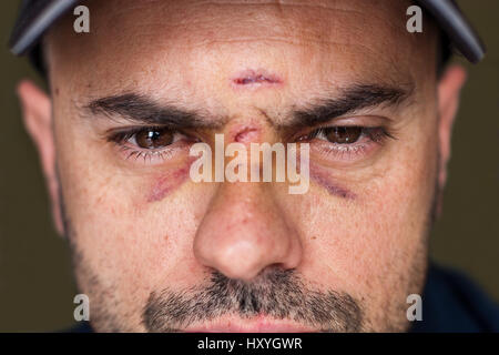 Face of an injured man with wounds and black eyes. Soft focus. Stock Photo