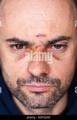 Face of an injured man with wounds and black eyes. Soft focus. Stock Photo