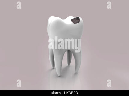 Tooth decay. Computer illustration of a tooth with a cavity and a close ...