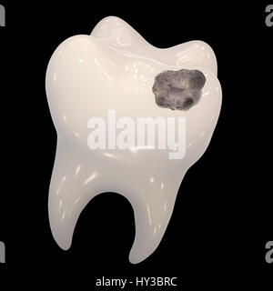 Tooth decay. Computer illustration of a tooth with a cavity and a close ...