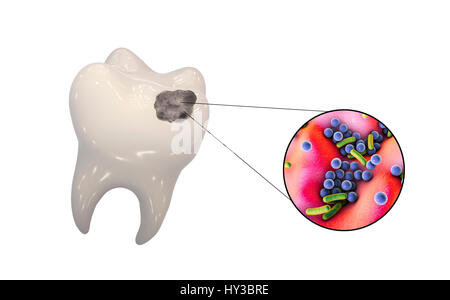 Streptococcus mutans bacteria, computer illustration. Streptococcus ...