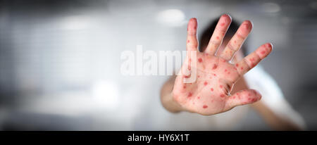 Hand foot and mouth disease a rash of painful blister and dry scaly ...