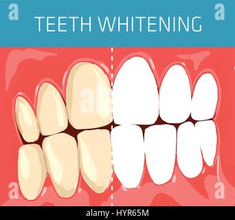 Medical and healthcare concept. Regular dental occlusion image. Teeth whitening visual scheme Stock Vector