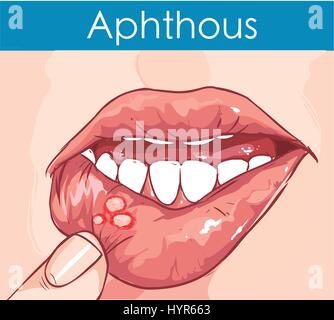 vector illustration of a Woman with aphthae on lip. Stock Vector