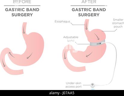 Illustration of gastric banding. A laparoscopic adjustable gastric band ...