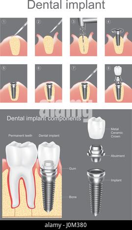 Dental implant is an artificial tooth root that is placed into your jaw to hold a replacement tooth or bridge. Dental implants may be an option for pe Stock Vector