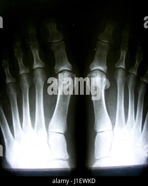 X-ray image of normal foot both side Stock Photo - Alamy
