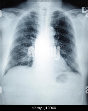 normal x-ray chest radiograph lung doctor thumb up Stock Photo - Alamy