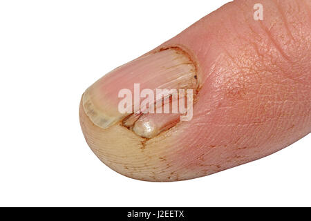A Damaged Split and Cracked finger nail isolated on a white background Stock Photo
