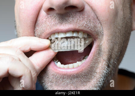 Man placing a bite plate in his mouth to protect his teeth at night from grinding caused by bruxism, close up view of his hand and the appliance Stock Photo