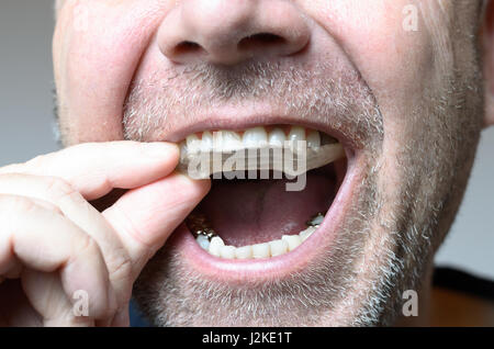 Man placing a bite plate in his mouth to protect his teeth at night from grinding caused by bruxism, close up view of his hand and the appliance Stock Photo