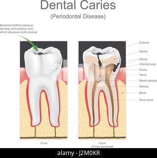 Dental caries is the scientific term for tooth decay or cavities. It is caused by specific types of bacteria. They produce acid that destroys the toot Stock Vector
