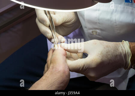 Podologist works with the patient's nail Stock Photo