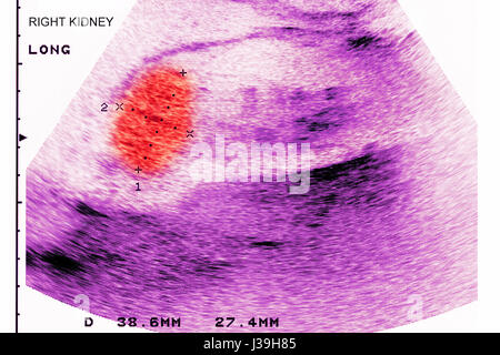 KIDNEY CANCER, SONOGRAPHY Stock Photo