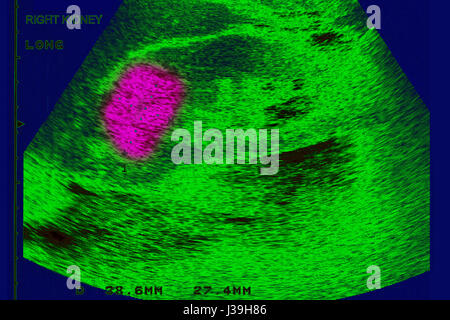 KIDNEY CANCER, SONOGRAPHY Stock Photo