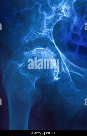 FRACTURED HIP, X-RAY Stock Photo