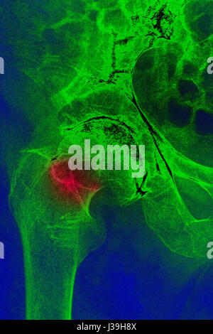 FRACTURED HIP, X-RAY Stock Photo